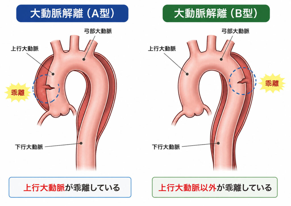 大動脈解離 A型、B型