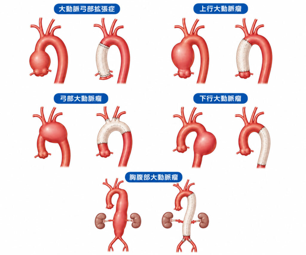 胸部大動脈瘤、上行置換から胸腹部置換まで